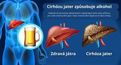Postup ztučnění jater do cirhózy